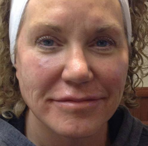 Bellafill Before & After Patient #116