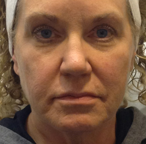 Bellafill Before & After Patient #116