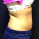 CoolSculpting Before & After Patient #186