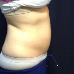 CoolSculpting Before & After Patient #186