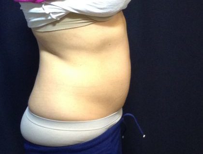 CoolSculpting Before & After Patient #186