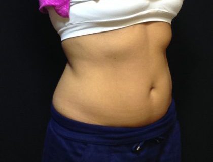 CoolSculpting Before & After Patient #186