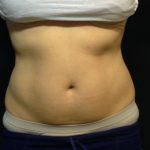 CoolSculpting Before & After Patient #186