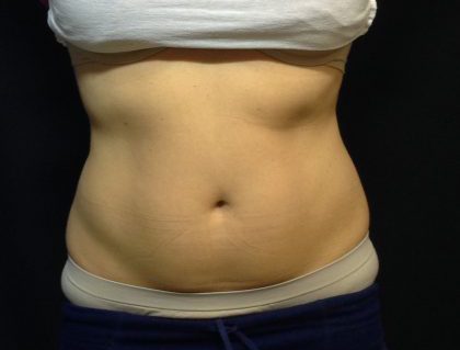 CoolSculpting Before & After Patient #186