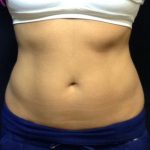 CoolSculpting Before & After Patient #186