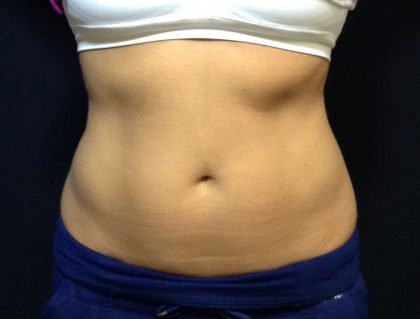 CoolSculpting Before & After Patient #186