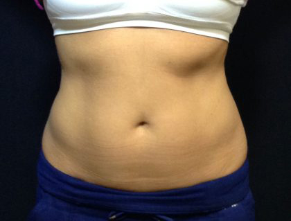 CoolSculpting Before & After Patient #186