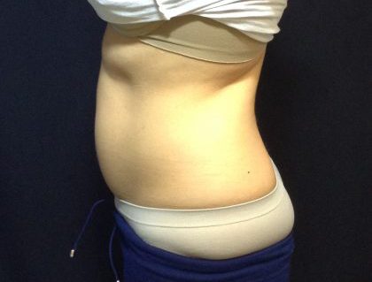 CoolSculpting Before & After Patient #186