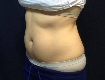 CoolSculpting Before & After Patient #186