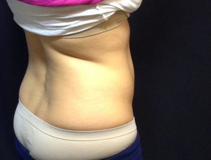 CoolSculpting Before & After Patient #186