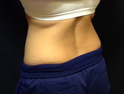 CoolSculpting Before & After Patient #186