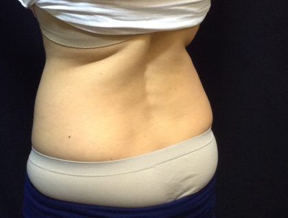 CoolSculpting Before & After Patient #186