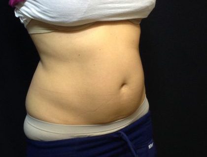 CoolSculpting Before & After Patient #186