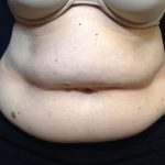 CoolSculpting Before & After Patient #210