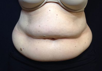 CoolSculpting Before & After Patient #210