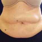 CoolSculpting Before & After Patient #210