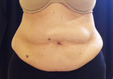 CoolSculpting Before & After Patient #210