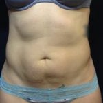 CoolSculpting Before & After Patient #123