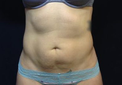 CoolSculpting Before & After Patient #123