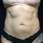 CoolSculpting Before & After Patient #123