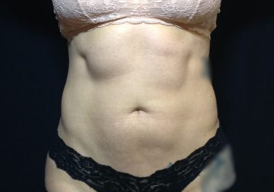 CoolSculpting Before & After Patient #123