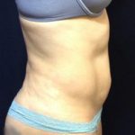 CoolSculpting Before & After Patient #123