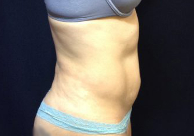 CoolSculpting Before & After Patient #123