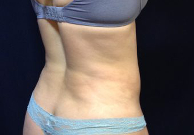 CoolSculpting Before & After Patient #123