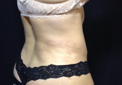 CoolSculpting Before & After Patient #123