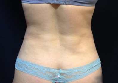 CoolSculpting Before & After Patient #123