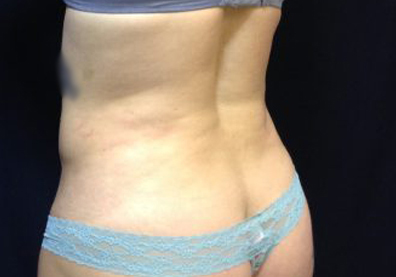 CoolSculpting Before & After Patient #123