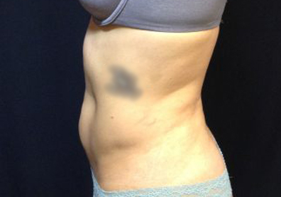 CoolSculpting Before & After Patient #123