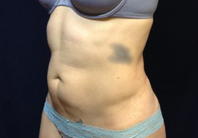 CoolSculpting Before & After Patient #123