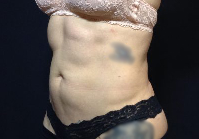 CoolSculpting Before & After Patient #123