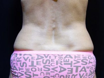 CoolSculpting Before & After Patient #201