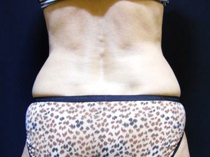 CoolSculpting Before & After Patient #201