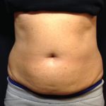 CoolSculpting Before & After Patient #171