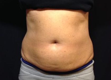 CoolSculpting Before & After Patient #171