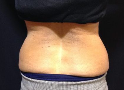 CoolSculpting Before & After Patient #171