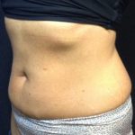 CoolSculpting Before & After Patient #171