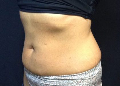 CoolSculpting Before & After Patient #171