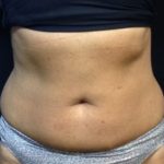 CoolSculpting Before & After Patient #171