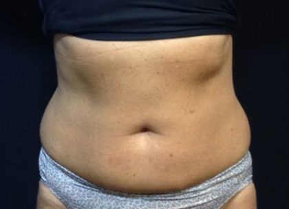 CoolSculpting Before & After Patient #171