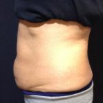 CoolSculpting Before & After Patient #171