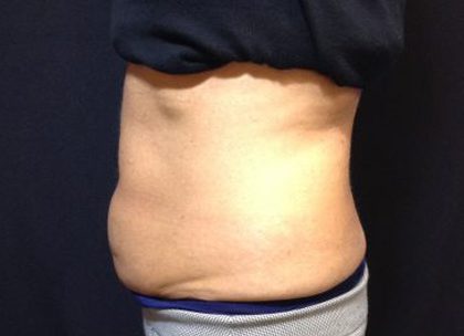 CoolSculpting Before & After Patient #171