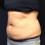 CoolSculpting Before & After Patient #171