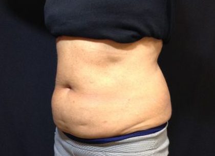 CoolSculpting Before & After Patient #171