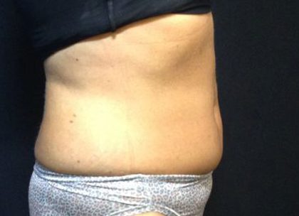 CoolSculpting Before & After Patient #171