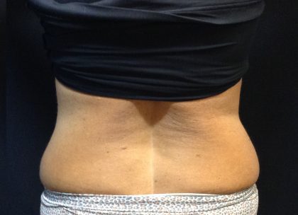 CoolSculpting Before & After Patient #171