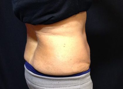 CoolSculpting Before & After Patient #171